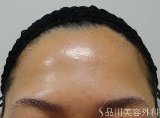 症例NO.72380のBEFORE写真