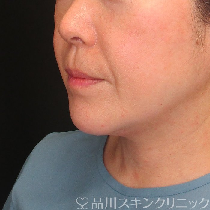 症例NO.73948のBEFORE写真