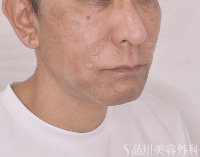 症例NO.66043のAFTER写真