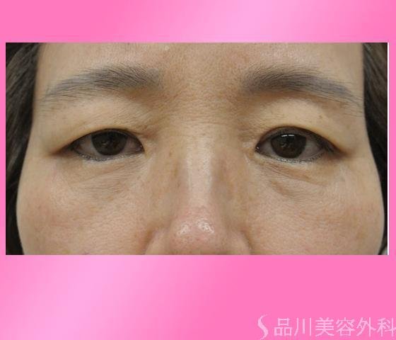 症例NO.14482のBEFORE写真