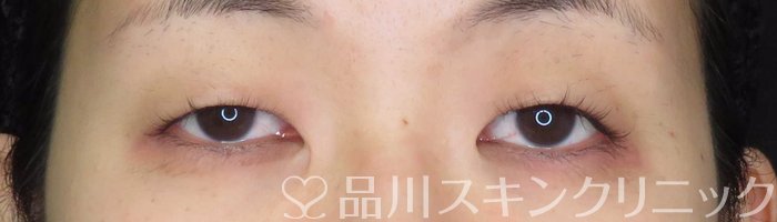 症例NO.67979のBEFORE写真