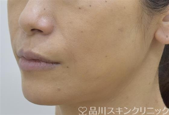 症例NO.53406のAFTER写真