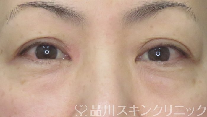 症例NO.72675のBEFORE写真