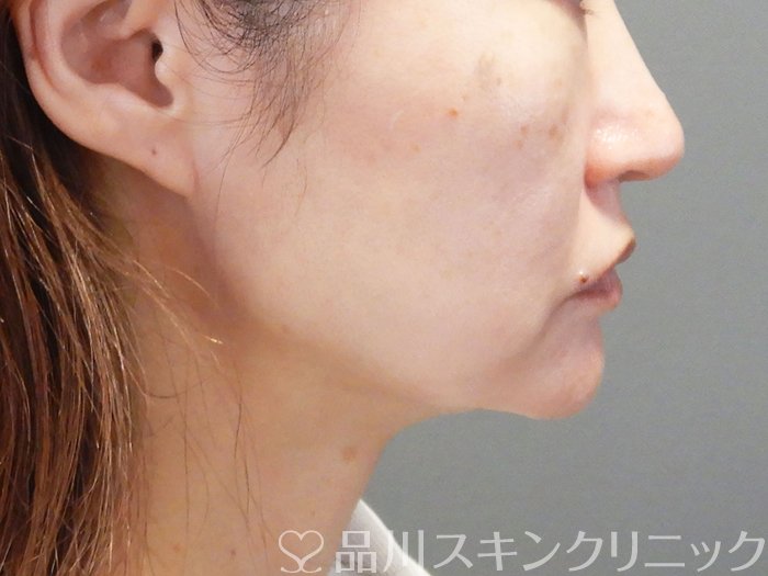 症例NO.72393のAFTER写真