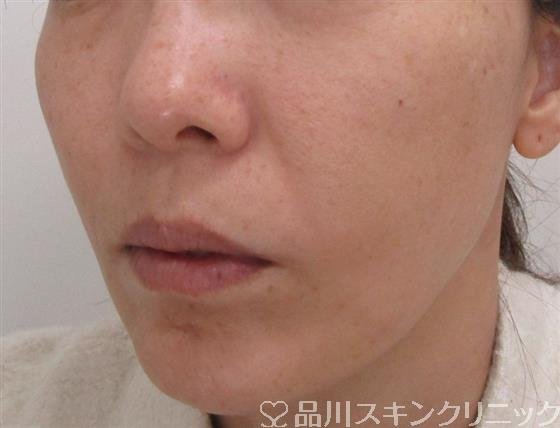 症例NO.43048のAFTER写真