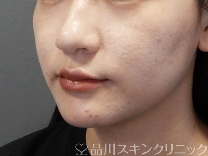 症例NO.73327のAFTER写真