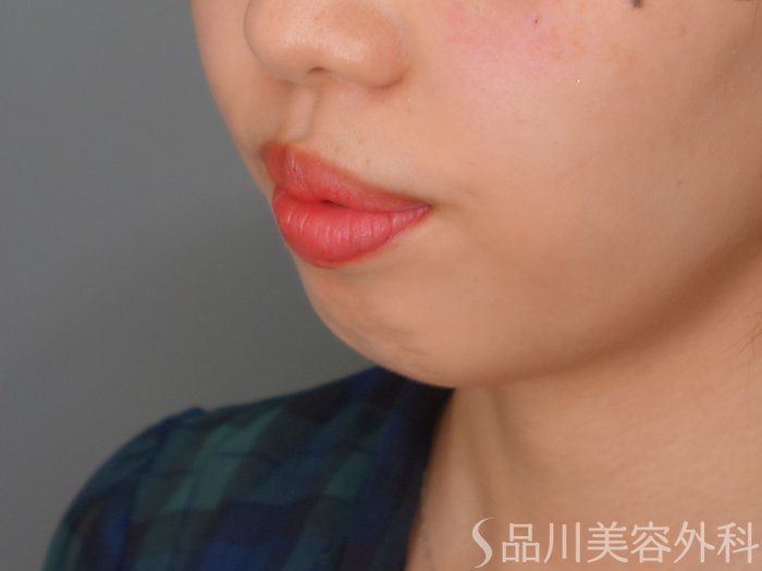 症例NO.69878のBEFORE写真