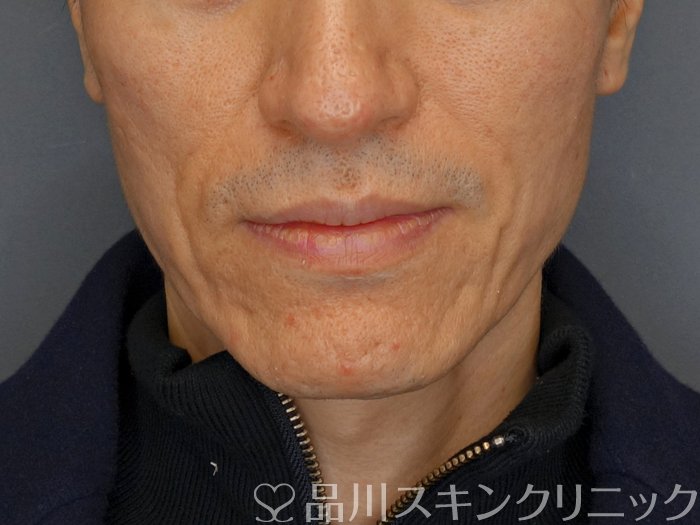 症例NO.72817のBEFORE写真