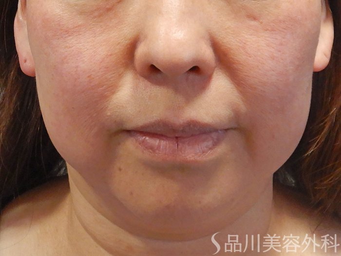 症例NO.69469のBEFORE写真