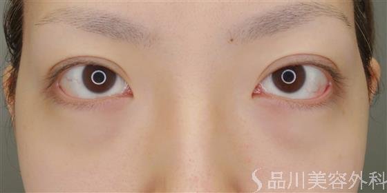 症例NO.49420のBEFORE写真