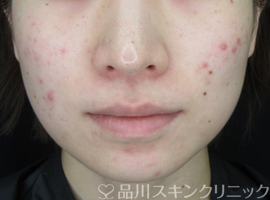 症例NO.70265のBEFORE写真