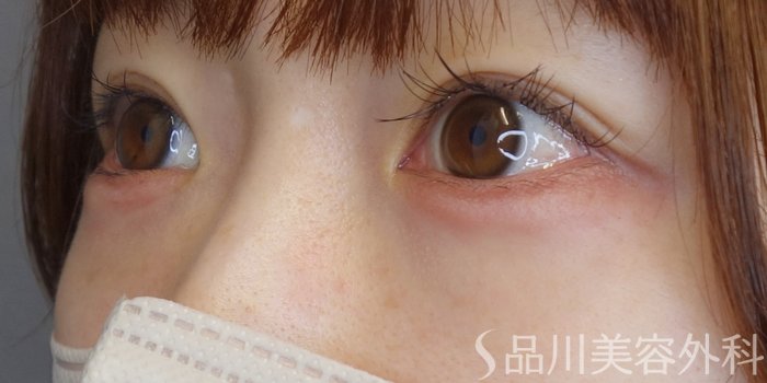 症例NO.70422のAFTER写真