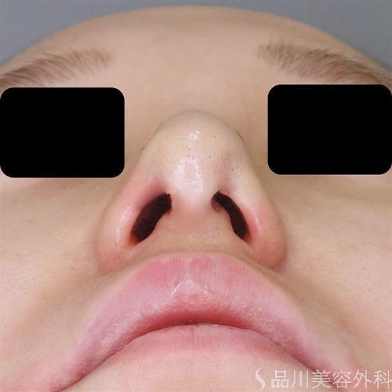 症例NO.52045のAFTER写真