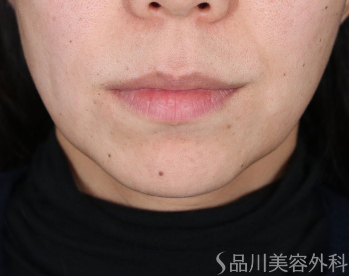 症例NO.72811のBEFORE写真