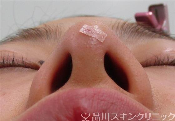症例NO.34780のAFTER写真