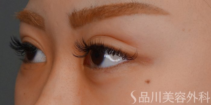 症例NO.73515のAFTER写真