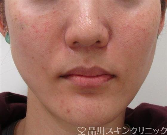 症例NO.32642のAFTER写真