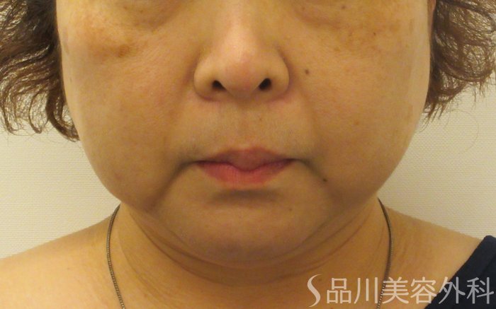症例NO.71895のBEFORE写真