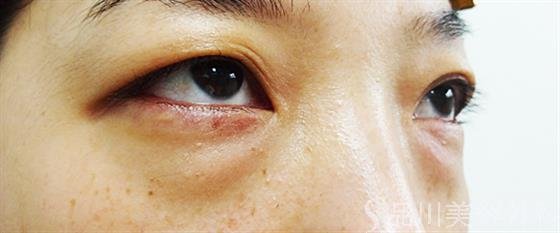 症例NO.25302のBEFORE写真