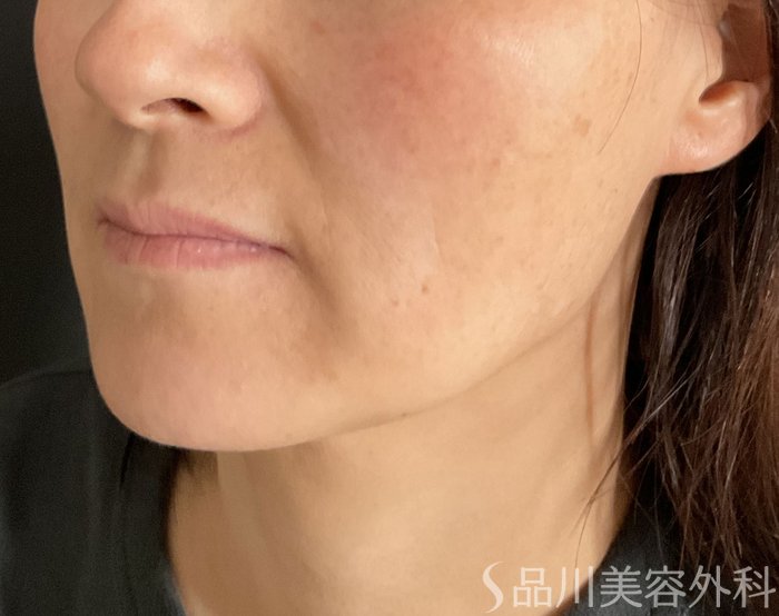 症例NO.75228のBEFORE写真