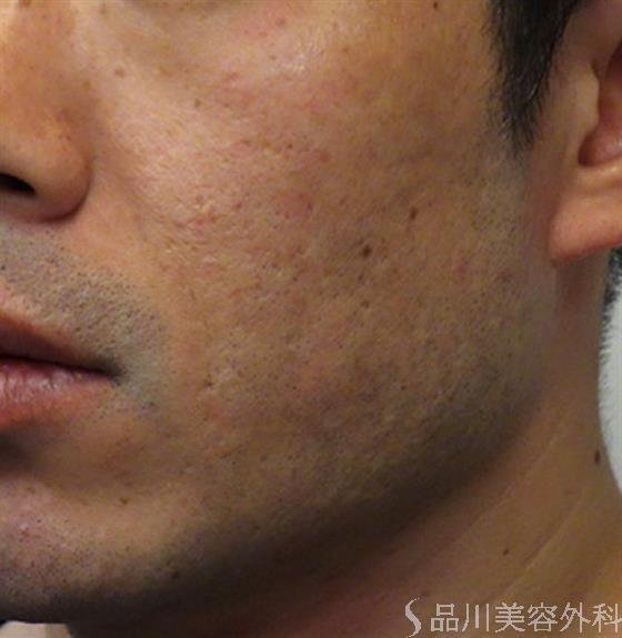 症例NO.47064のBEFORE写真