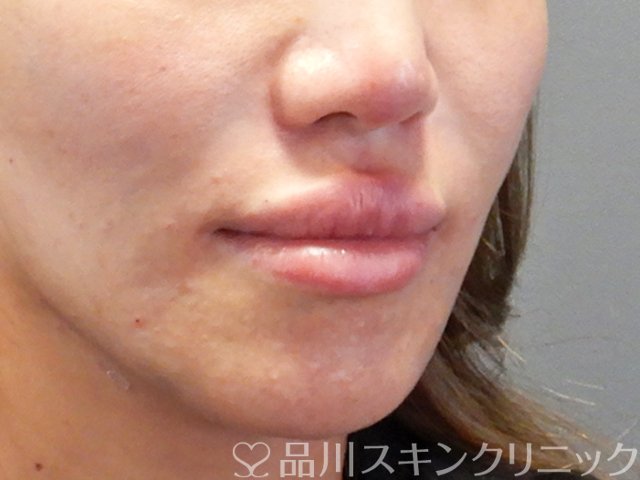症例NO.71241のAFTER写真