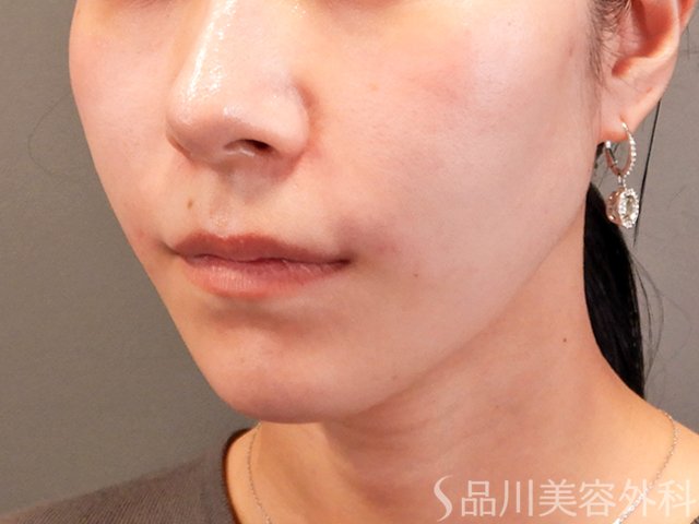 症例NO.70322のAFTER写真