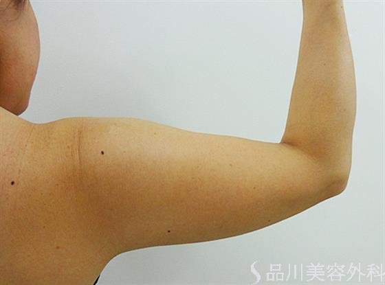 症例NO.25303のBEFORE写真