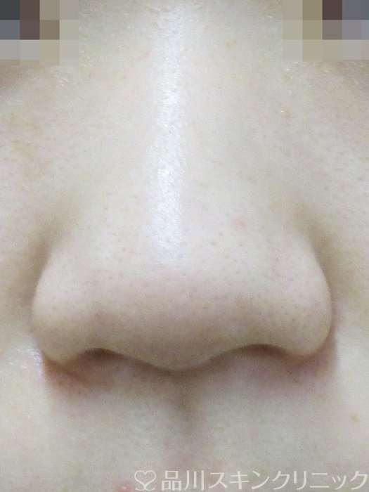 症例NO.70200のBEFORE写真