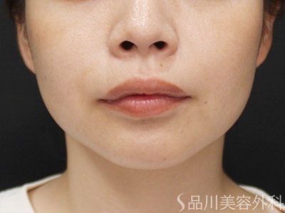 症例NO.75007のAFTER写真