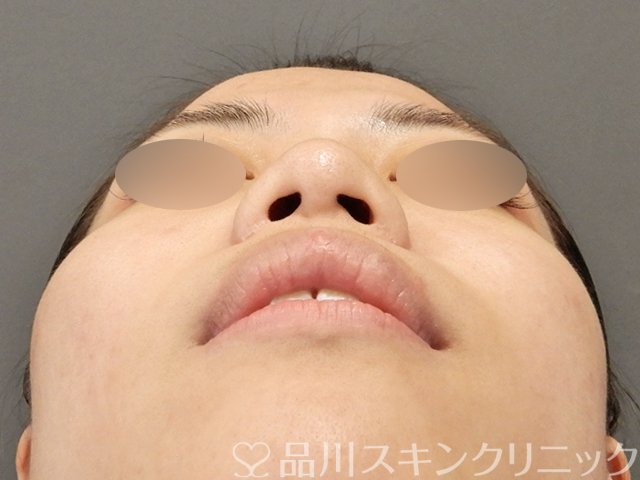 症例NO.75040のBEFORE写真