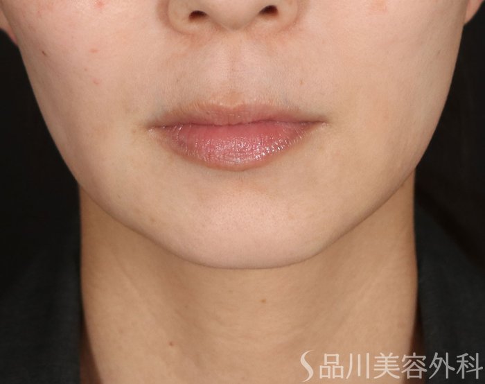 症例NO.72713のBEFORE写真