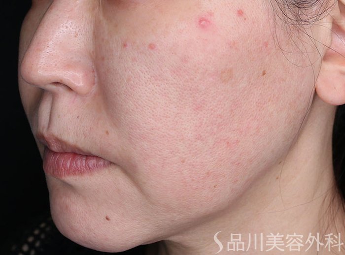 症例NO.69596のBEFORE写真