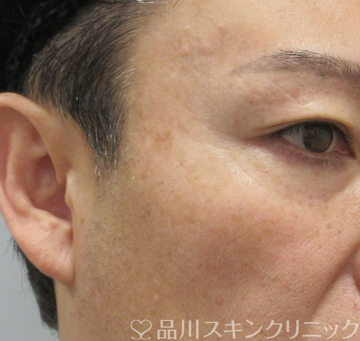 症例NO.74253のBEFORE写真