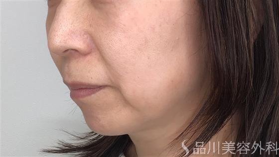 症例NO.58999のBEFORE写真