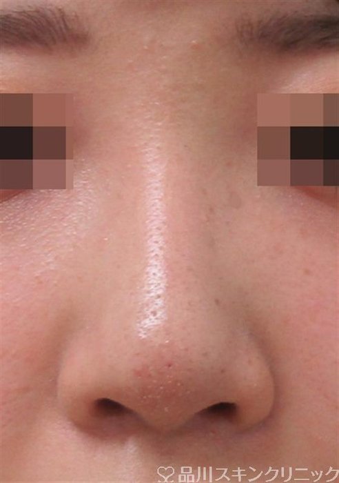 症例NO.29161のAFTER写真