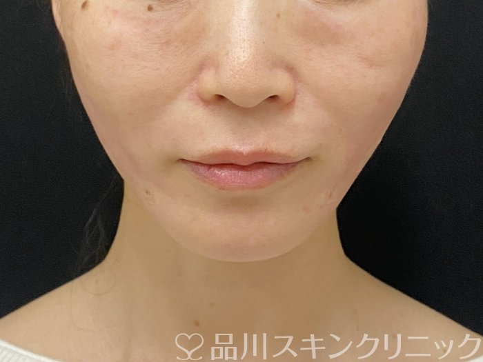 症例NO.74299のAFTER写真