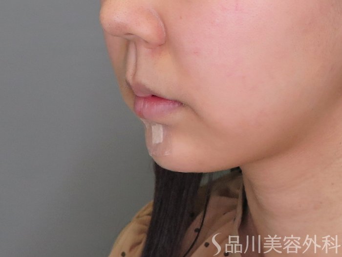 症例NO.71299のAFTER写真