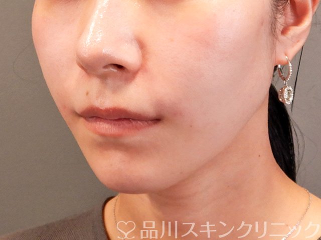 症例NO.70322のAFTER写真