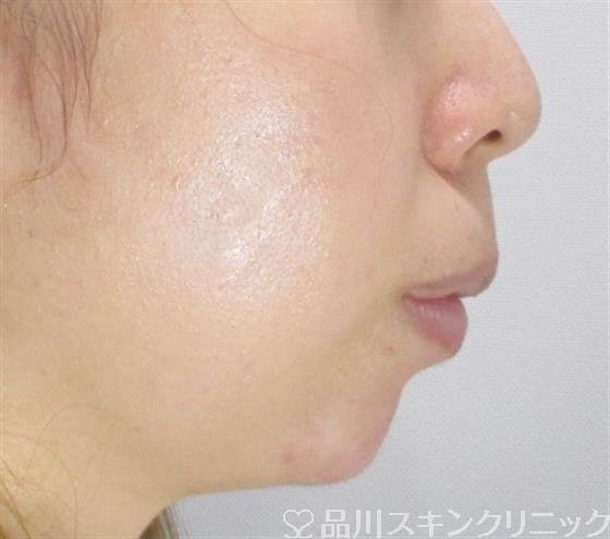 症例NO.35557のAFTER写真