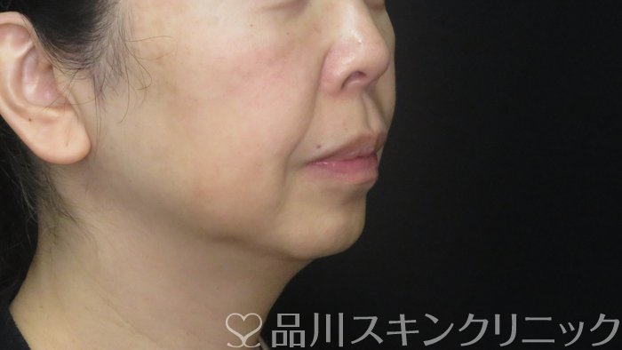 症例NO.72428のBEFORE写真