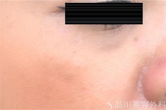 症例NO.18375のAFTER写真