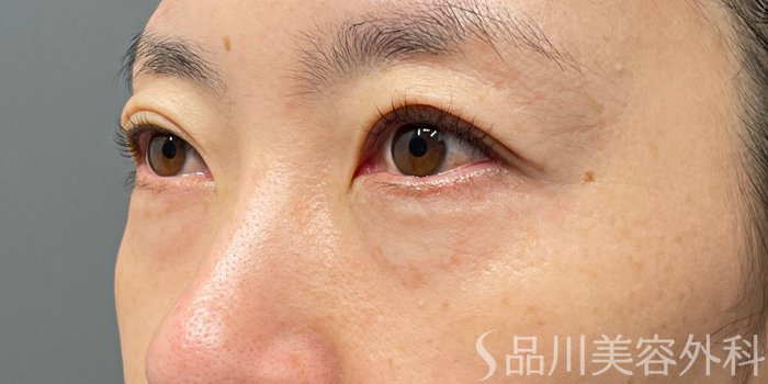 症例NO.74872のBEFORE写真