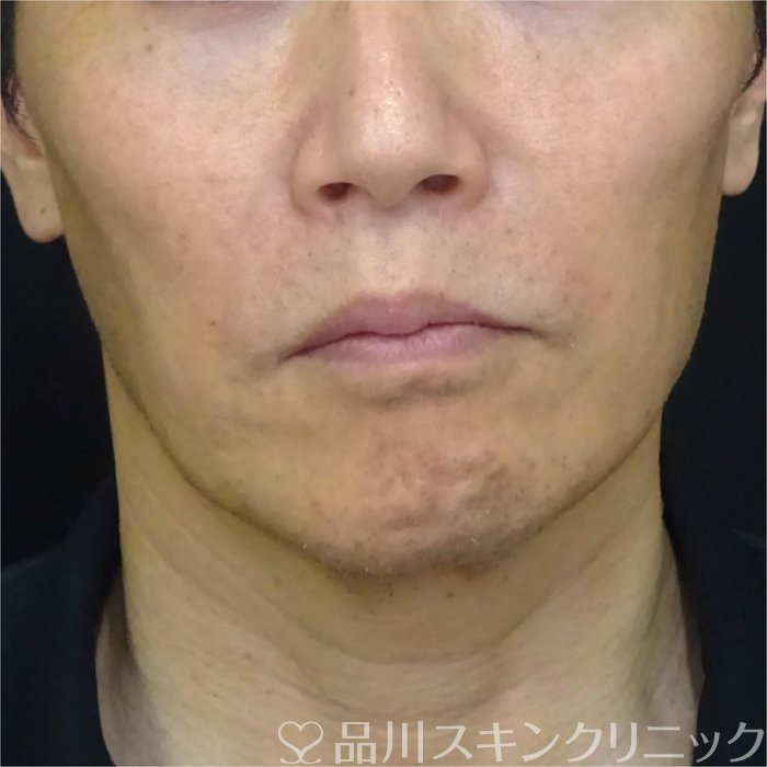 症例NO.72651のAFTER写真