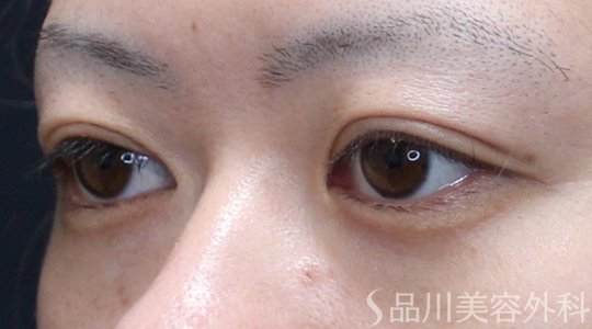 症例NO.74948のAFTER写真