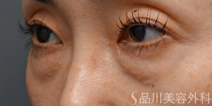 症例NO.72539のBEFORE写真