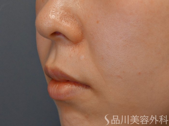 症例NO.69344のBEFORE写真