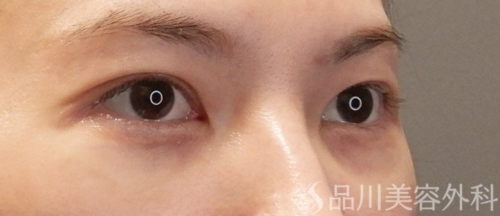 症例NO.71728のAFTER写真