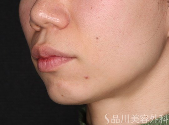 症例NO.73125のBEFORE写真