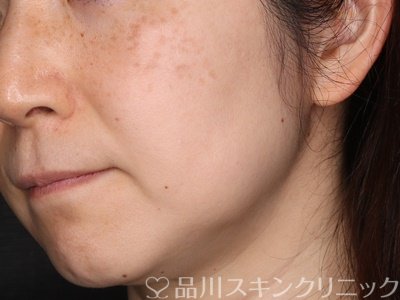 症例NO.71346のBEFORE写真